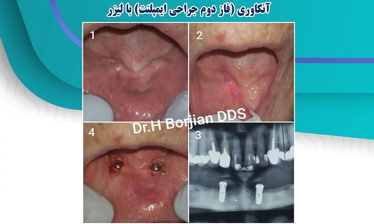 Acknowledgment (The second phase of implant surgery) with a laser | The best gum surgeon in Isfahan