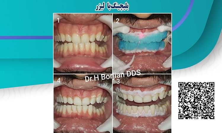 Bleaching with laser | The best gum surgeon in Isfahan