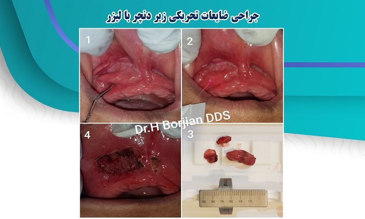 جراحی ضایعات تحریکی زیر دنچر با لیزر | بهترین جراح لثه اصفهان