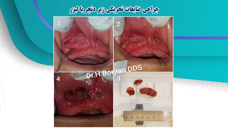 جراحی ضایعات تحریکی زیر دنچر با لیزر | بهترین جراح لثه اصفهان
