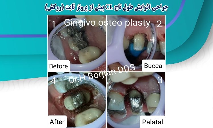 CL crown lengthening surgery before fixed prosthesis (the cover) | The best gum surgeon in Isfahan