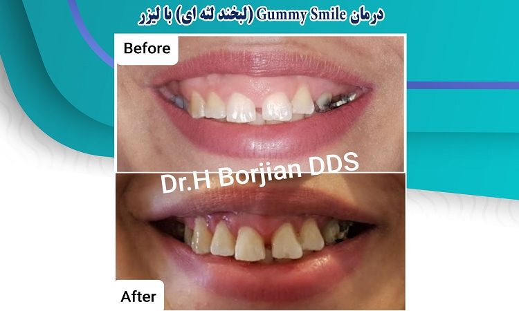 Gummy Smile treatment (gummy smile) with a laser | The best gum surgeon in Isfahan