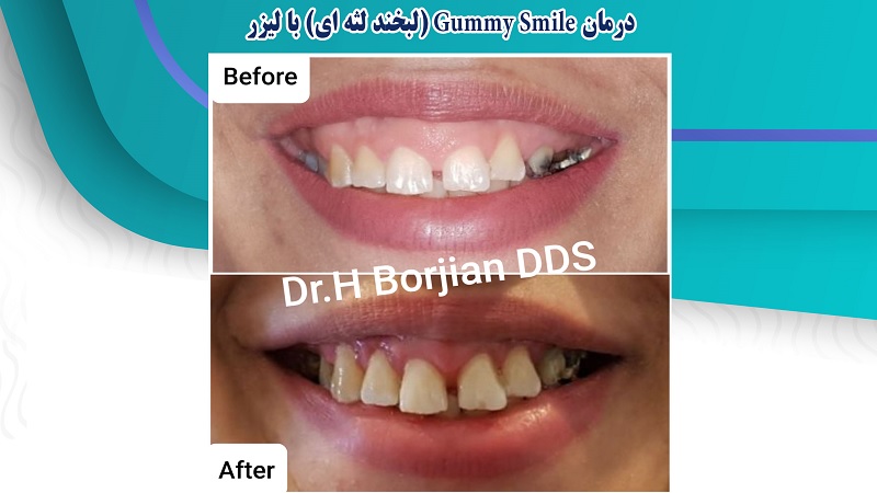 درمان Gummy Smile (لبخند لثه ای) با لیزر | بهترین جراح لثه اصفهان