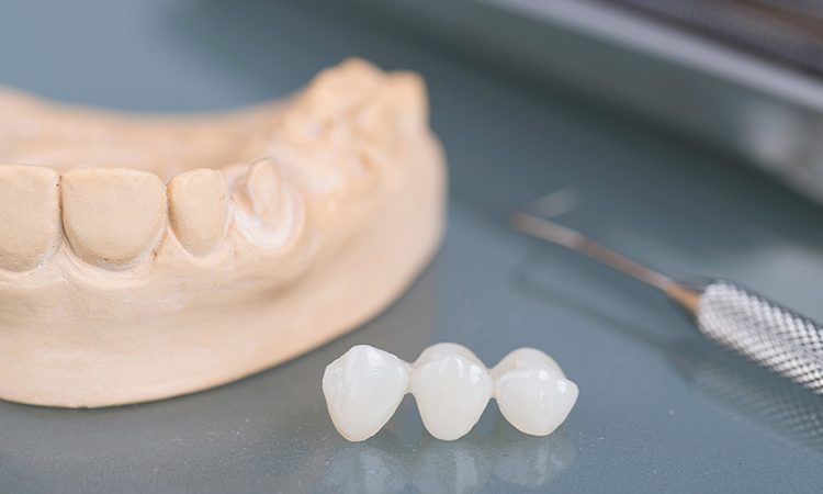 Connaître les types de stratifiés dentaires | Le meilleur chirurgien des gencives à Ispahan