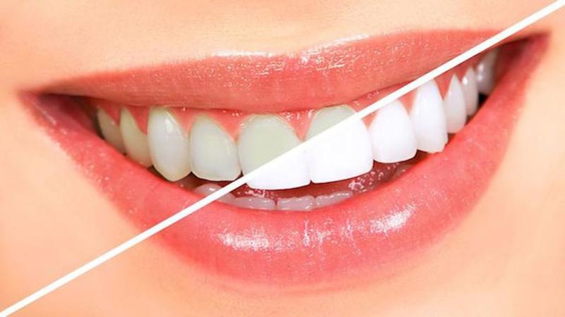 اقدامات لازم در صورت تغییر رنگ روکش دندان | بهترین دندانپزشک اصفهان