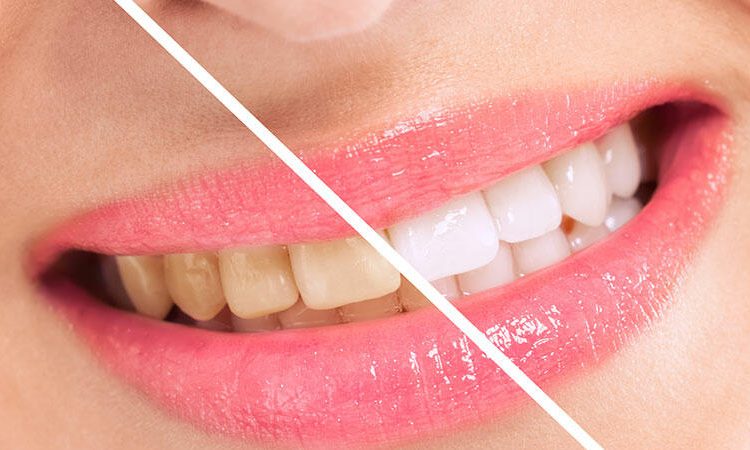 التدابير اللازمة في حالة تغير لون قشرة الأسنان | افضل دكتور اسنان في اصفهان