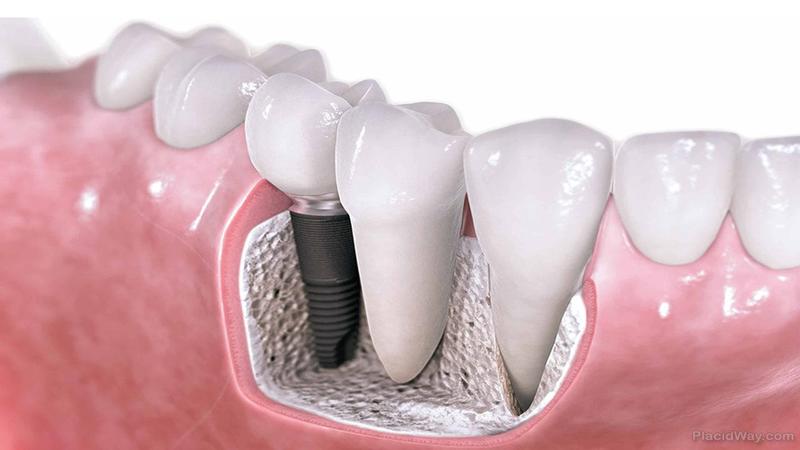 بررسی انواع روش های کاشت دندان | بهترین دندانپزشک اصفهان