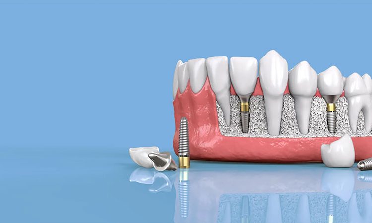 Examining the types of dental implant methods | The best dentist in Isfahan