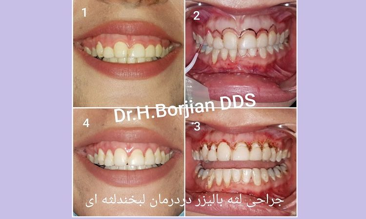 نمونه جراحی زیبایی لثه با استفاده از لیزر دندانپزشکی | The best cosmetic dentist in Isfahan