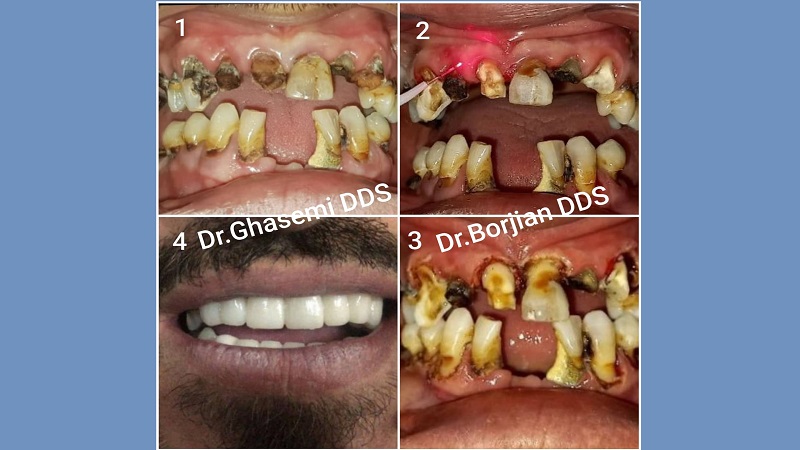 عينة من جراحة اللثة بالليزر بدون غرز ونزيف | افضل دكتور اسنان تجميلي في اصفهان