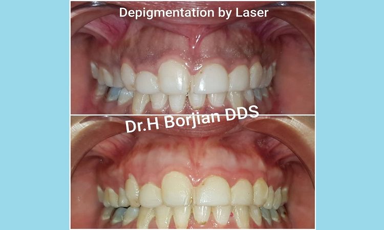Removal of dark gums with laser (Laser depigmentation) | The best cosmetic dentist in Isfahan