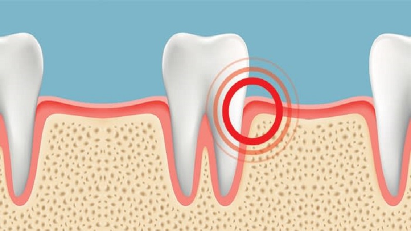 What are the signs and symptoms of gum infection? | The best gum surgeon in Isfahan