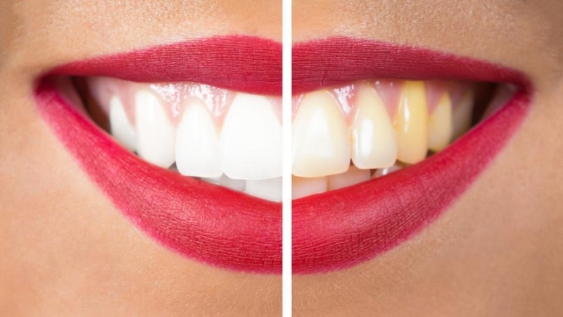 علل ایجاد لکه و زرد شدن در روکش دندان | بهترین ایمپلنت اصفهان