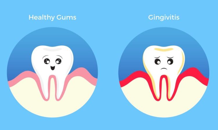 What are the causes of gingivitis? | The best cosmetic dentist in Isfahan
