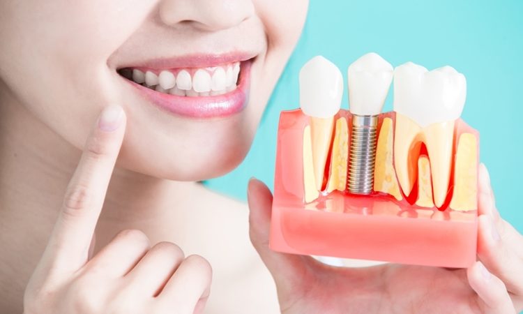 What are the advantages of dental implants compared to artificial teeth? | The best dentist in Isfahan