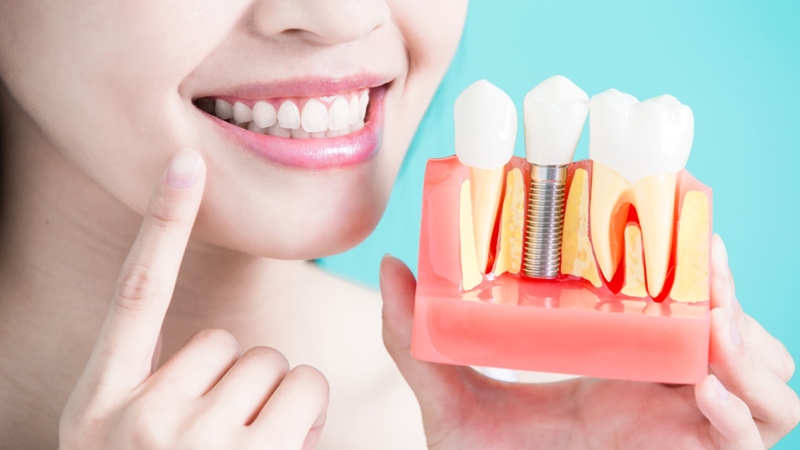 What are the advantages of dental implants compared to artificial teeth? | The best dentist in Isfahan