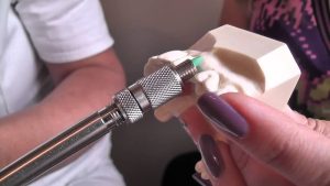 Quels sont les avantages des implants dentaires par rapport aux dents artificielles ? | Le meilleur dentiste d'Ispahan