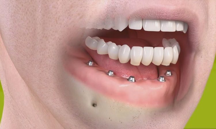 استخدامات زراعة الاسنان | أفضل جراح لثة في اصفهان