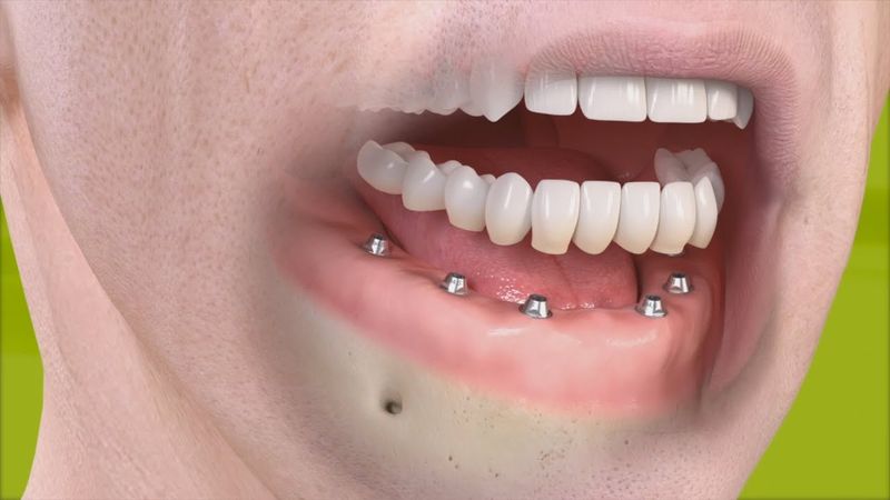 موارد استفاده از ایمپلنت دندان | بهترین جراح لثه اصفهان