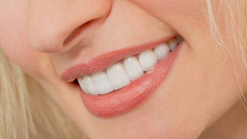 نکاتی مهم برای پیش از لمینت کردن دندانها | بهترین ایمپلنت اصفهان