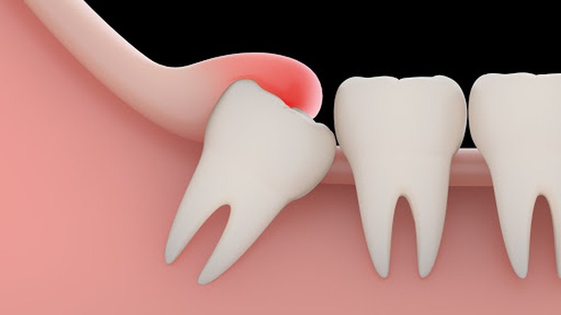 Wisdom tooth extraction and its surgery | The best dentist in Isfahan