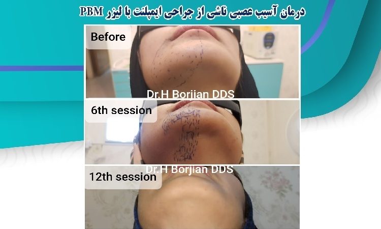 درمان آسیب عصبی ناشی از جراحی ایمپلنت با لیزر PBM | أفضل جراح لثة في اصفهان