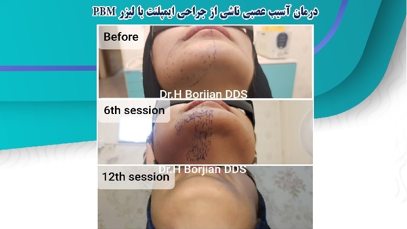 Treatment of nerve damage caused by implant surgery with PBM laser | The best gum surgeon in Isfahan