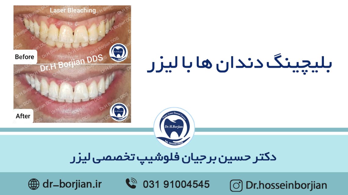 Laser tooth bleaching|The best dentist in Isfahan
