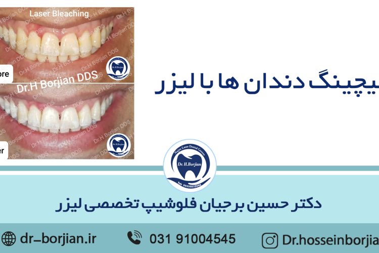 تبيض الأسنان بالليزر|افضل دكتور اسنان في اصفهان