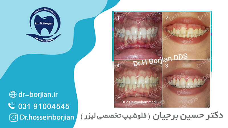 نمونه کار رفع تیرگی لثه با لیزر|The best dentist in Isfahan