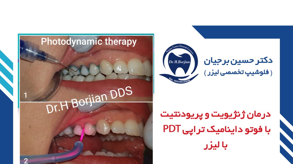 Treatment of gingivitis and periodontitis with PDT photodynamic therapy with laser|The best dentist in Isfahan
