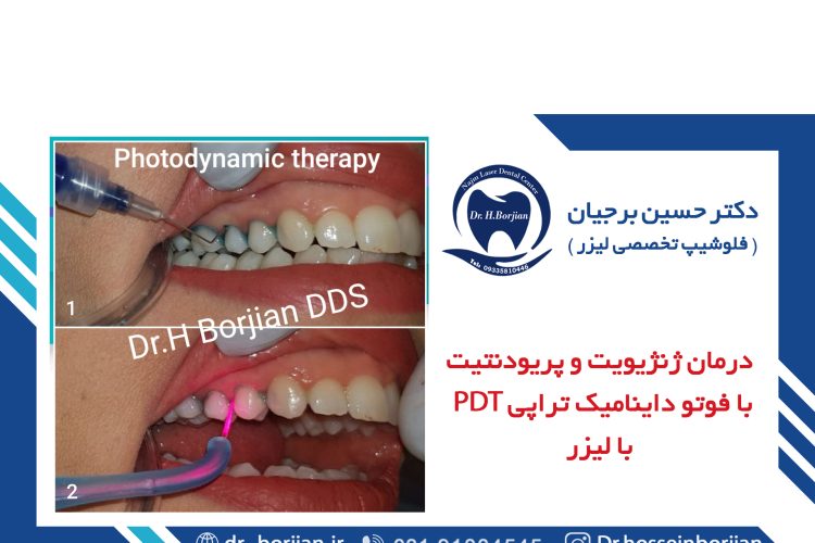 درمان ژنژیویت و پریودنتیت با فوتو داینامیک تراپی PDT با لیزر|بهترین دندانپزشک اصفهان