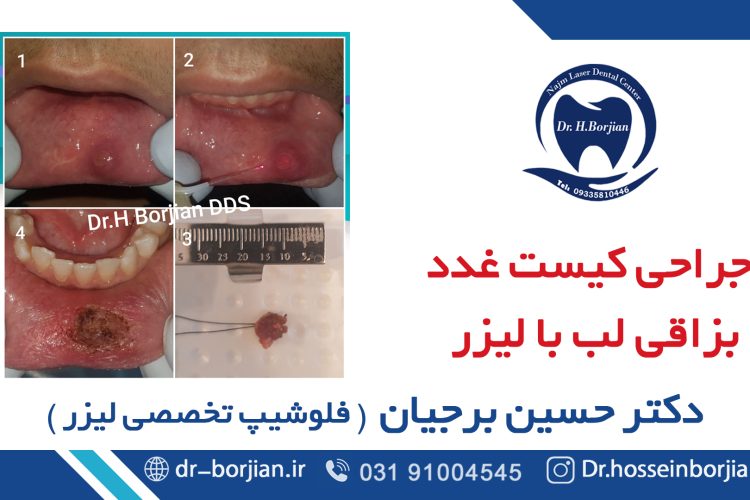 جراحی کیست غدد بزاقی لب با لیزر|بهترین دندانپزشک اصفهان