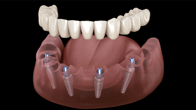 آشنایی با دندان مصنوعی ثابت بر پایه ایمپلنت | بهترین دندانپزشک اصفهان