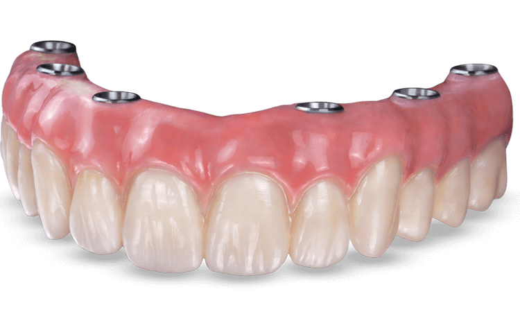 الإلمام بأسنان صناعية ثابتة تعتمد على الزرع | افضل دكتور اسنان في اصفهان