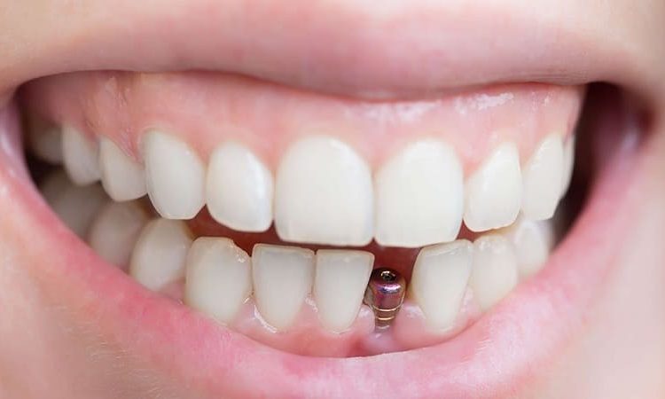 بررسی تاثیر دیابت بر میزان موفقیت ایمپلنت دندان | Le meilleur dentiste d'Ispahan