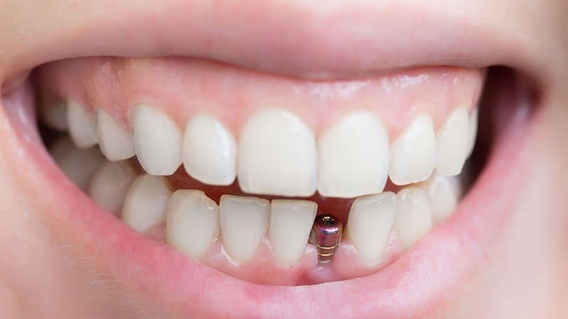 دراسة تأثير مرض السكري على نسبة نجاح زراعة الأسنان | افضل دكتور اسنان في اصفهان