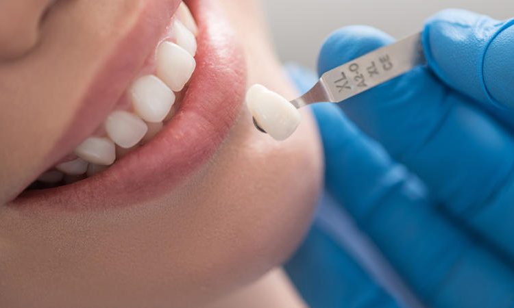 ما هو الفرق بين صفح وقشرة الأسنان؟ | افضل دكتور اسنان في اصفهان