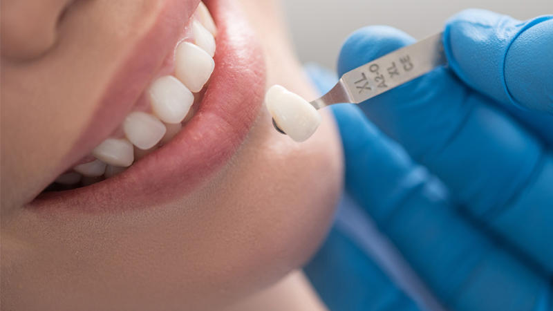 تفاوت لمینت با روکش دندان در چیست؟ | بهترین دندانپزشک اصفهان
