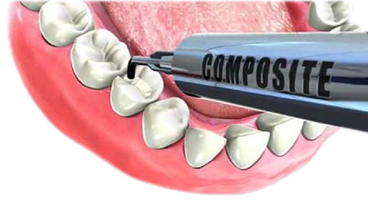 دلایل استفاده از کامپوزیت دندان چیست؟ | Le meilleur chirurgien des gencives à Ispahan