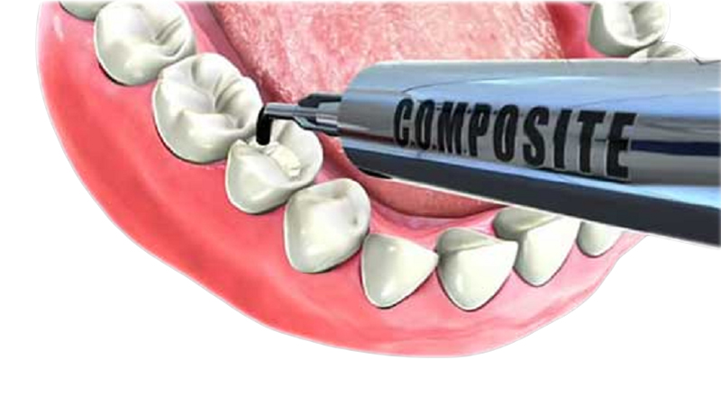 دلایل استفاده از کامپوزیت دندان چیست؟ | بهترین جراح لثه اصفهان