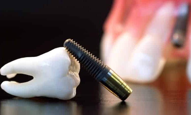 علل اهمیت کاشت مینی ایمپلنت | Le meilleur dentiste d'Ispahan