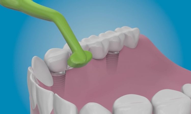Dental implant care with a special implant toothbrush | The best dentist in Isfahan
