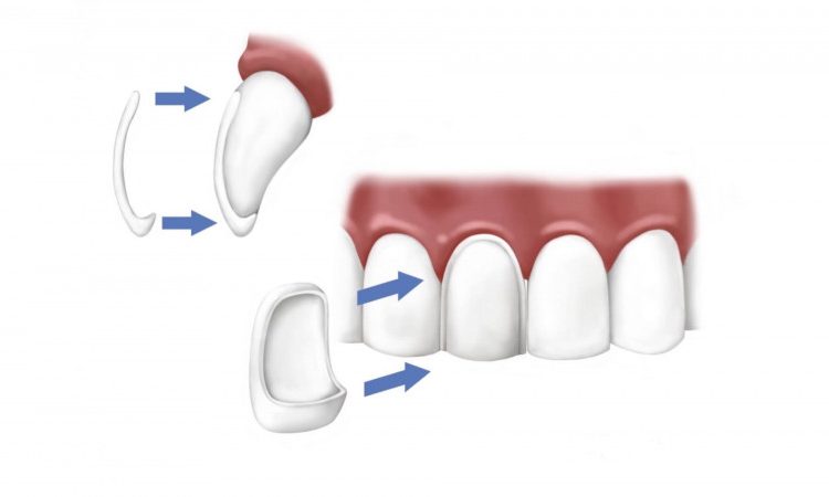 Quels sont les avantages et les inconvénients du stratifié dentaire ? | Le meilleur dentiste d'Ispahan