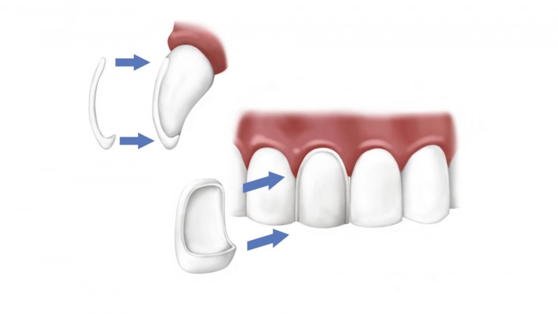 Quels sont les avantages et les inconvénients du stratifié dentaire ? | Le meilleur dentiste d'Ispahan