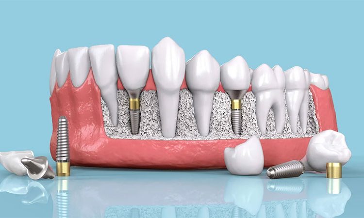 مضاعفات الغرسات المصغرة للعلاج النهائي للأسنان الاصطناعية | افضل دكتور اسنان في اصفهان