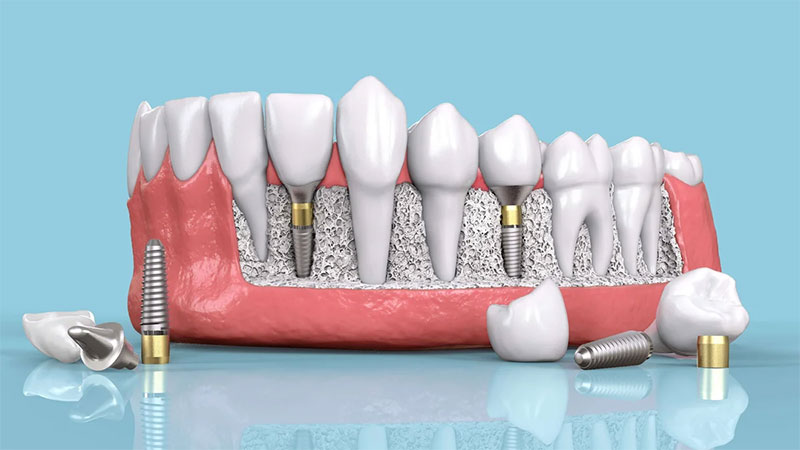 Complications of mini-implants for definitive dental prosthesis treatment | The best dentist in Isfahan