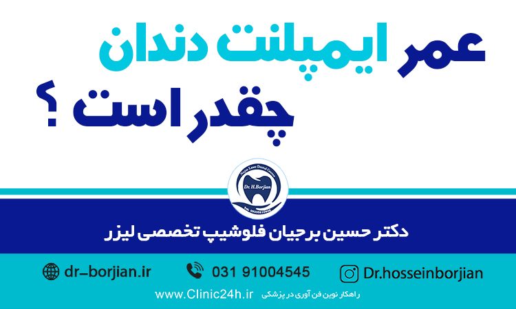 عمر ایمپلنت دندان چقدر است؟|بهترین دندانپزشک اصفهان
