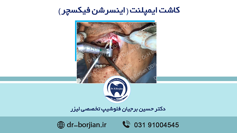 کاشت ایمپلنت|بهترین دندانپزشک اصفهان