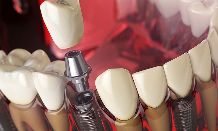 Examining dental implant options | The best gum surgeon in Isfahan